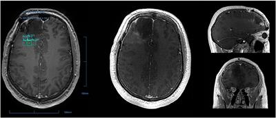 Blood-Brain Barrier Disruption in Neuro-Oncology: Strategies, Failures, and Challenges to Overcome